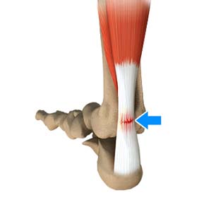 Achilles Tendon Tear Repair