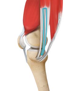 ACL Reconstruction Hamstring Method