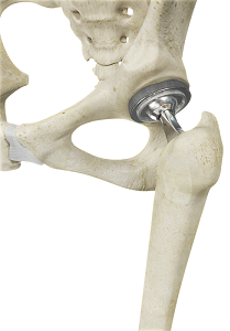 hip replacement total after anterior surgery joint osteoarthritis damaged pain treatments nonsurgical procedures