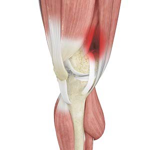 Iliotibial Band Syndrome Treatment Creve Coeur, MO