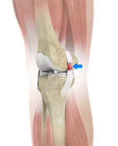 MCL Sprain