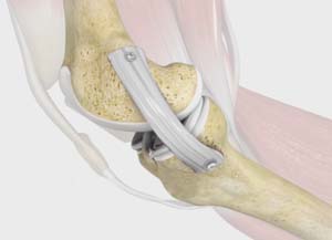 Medial Collateral Ligament Reconstruction