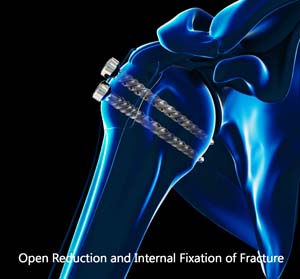 Open reduction & Internal Fixation of Proximal Humerus Fracture