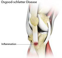 Osgood Schlatter Disease