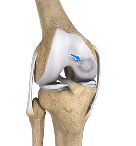 osteochondritis dissecans