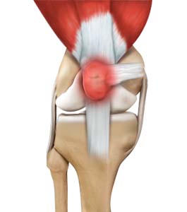 Patellofemoral Pain Syndrome