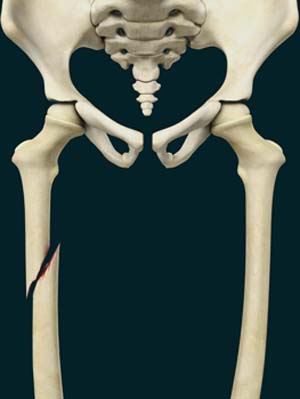Pediatric Thighbone (Femur) Fracture