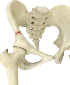 Complex Fracture Of The Pelvis: Do You Need An Orthopedic Surgeon? - Heiden  Orthopedics