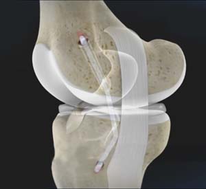 Posterior Cruciate Ligament Reconstruction