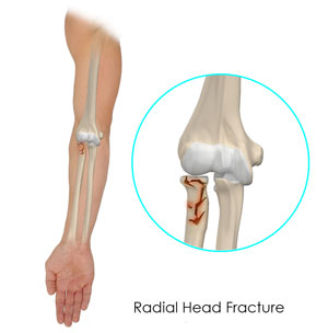 Skull Fracture: What It Is, Causes, Symptoms, Types & Treatments